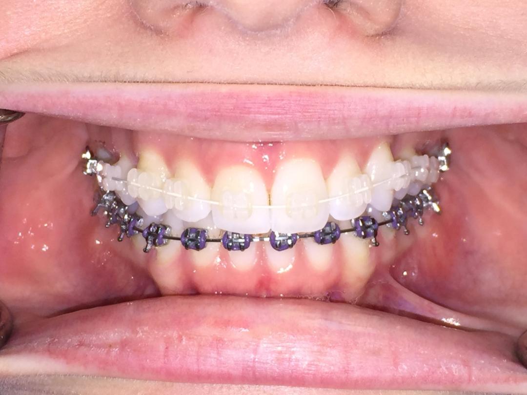 White and black braces