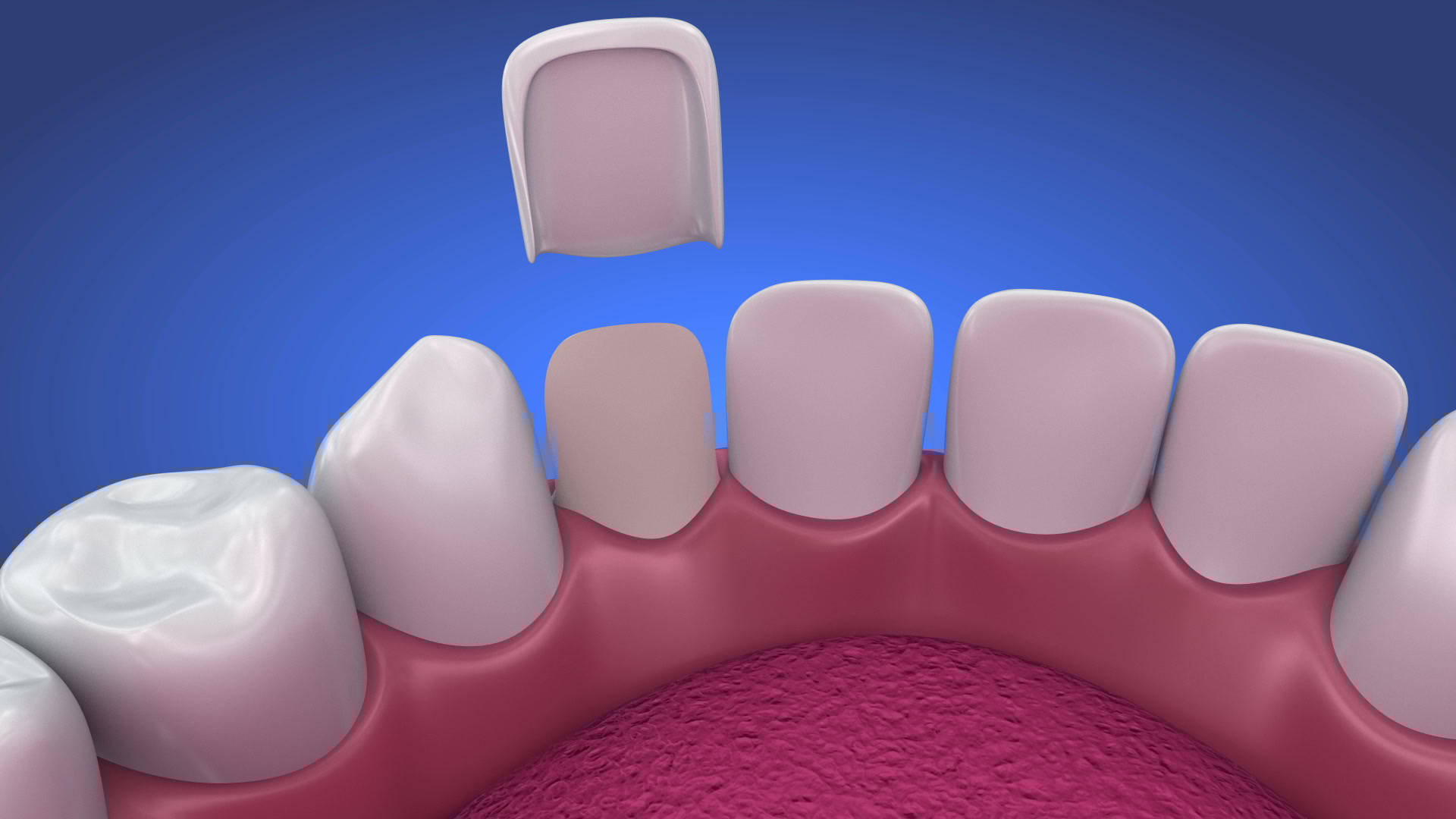 dental-veneers-porcelain-veneer-installation